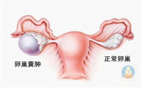 卵巢囊腫，抱腿壓涌泉穴，給你愛心呵護(hù)