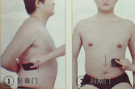 胃、十二指腸潰瘍—刮痧
