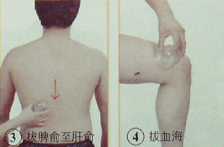 胃、十二指腸潰瘍的拔罐療法